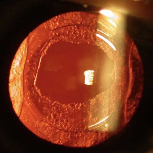 Laser behandelingen